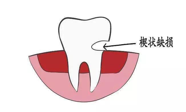 牙釉重度磨耗.jpg 牙釉重度磨耗.jpg