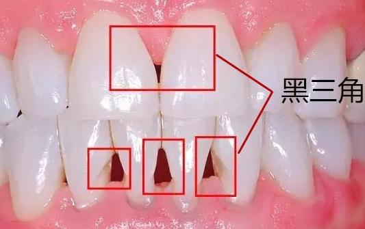 正畸后出现黑三角怎么办？